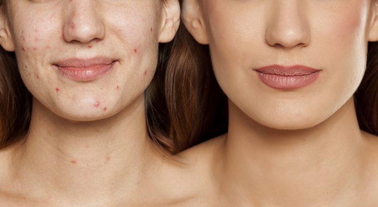 before after picture of lady with severe acne