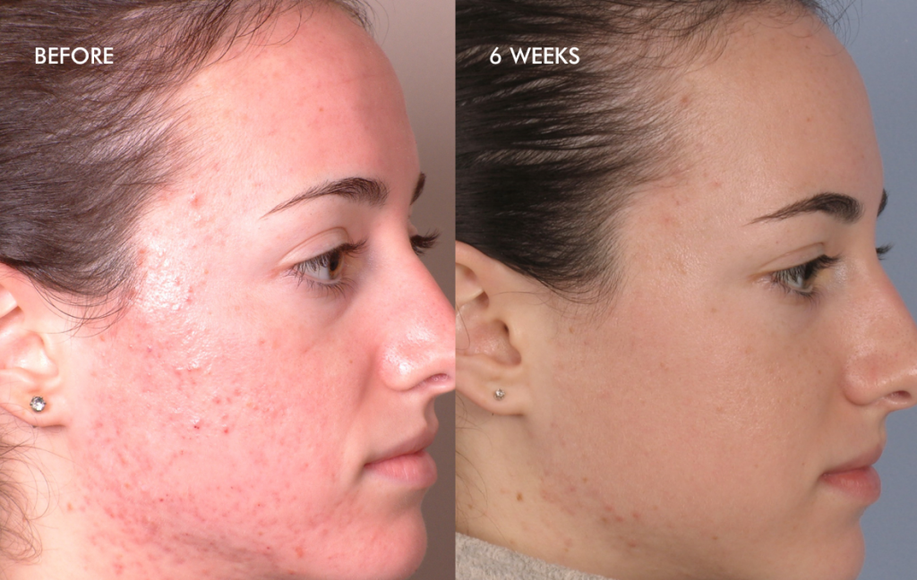 Improved skin beforeafter acne treatment