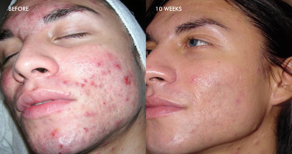 Dermal infusion improvement in Acne