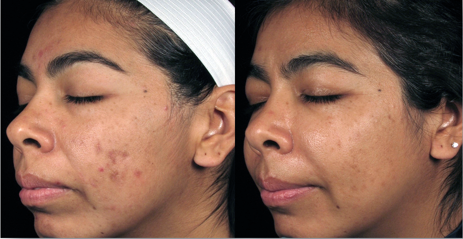 Improved acne scars after treatment