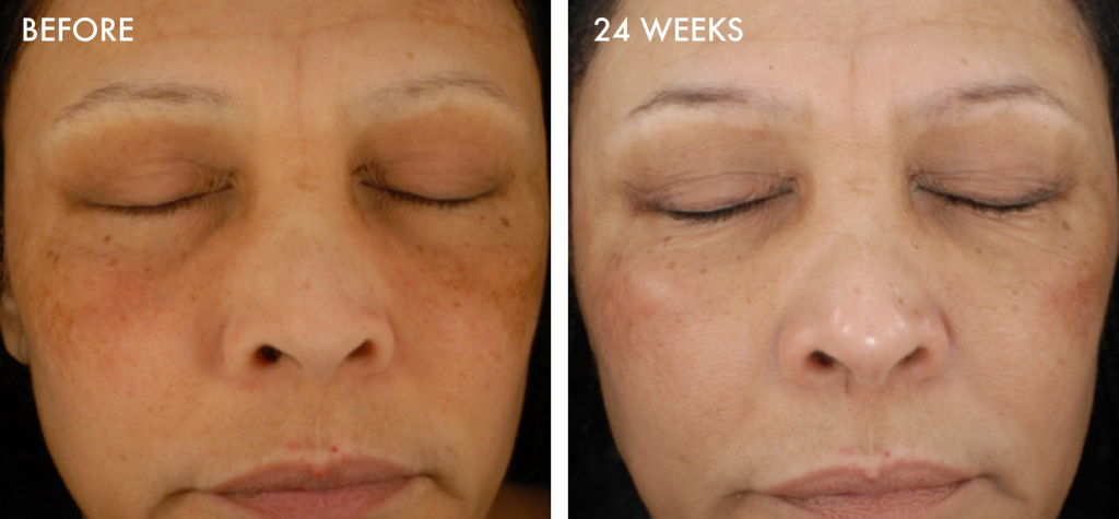 Improved complexion after treatment