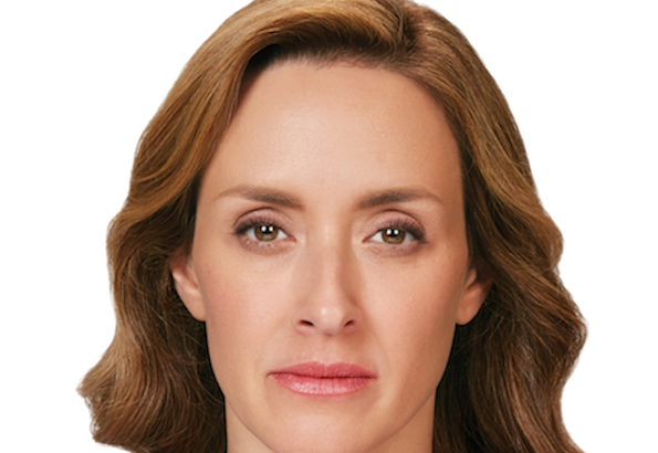 Resolution of wrinkles after Botox