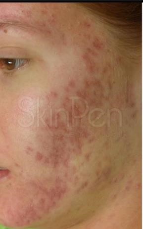 Extensive acne before skinpen microneedling procedure