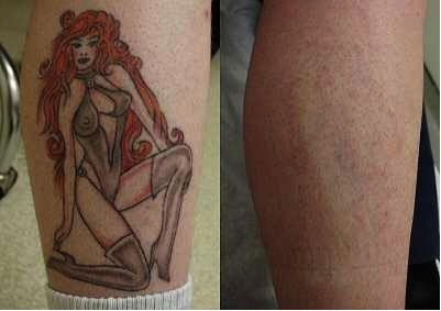 BeforeAfter image following laser tattoo removal Tattoo removal almost complete
