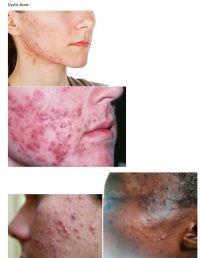 Anewskin Medspa Severe Acne Treatment Washington DC