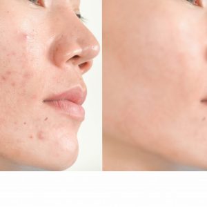Acne Treatment Products