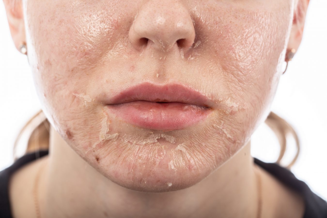 Why does Chemical Skin Peel Work?