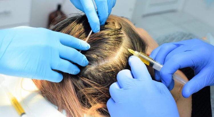 PRP injection hair restoration