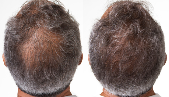 BeforeAfter Hair Restoration treatment