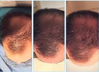 BeforeAfter Hair Restoration treatment
