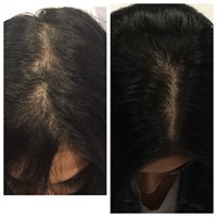 BeforeAfter Hair Restoration treatment