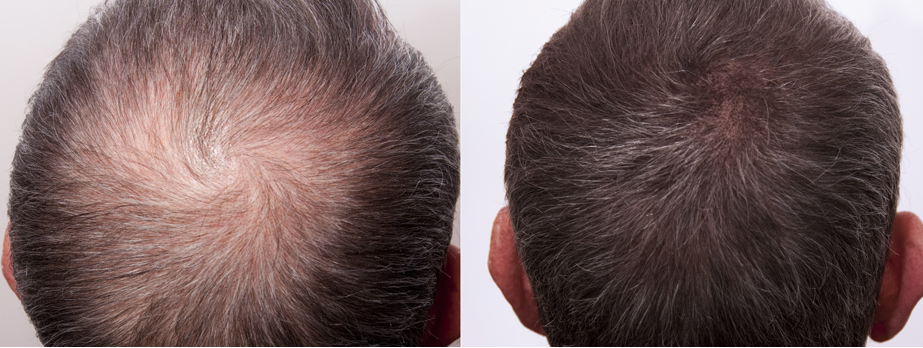 BeforeAfter Hair Restoration treatment