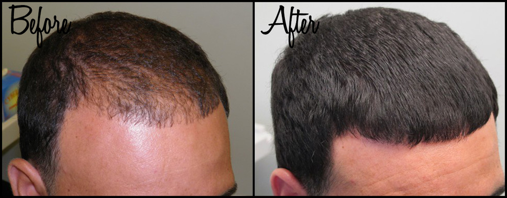 BeforeAfter Hair Restoration treatment