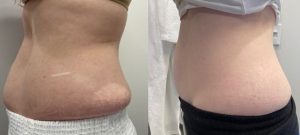 laser body sculpting