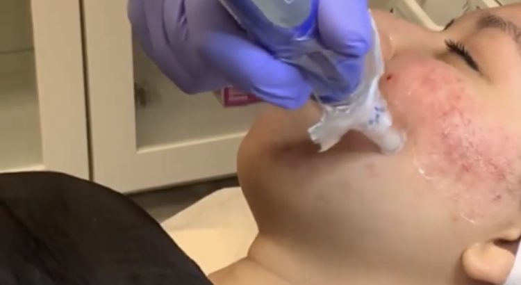 “PRP Microneedling Vampire Facial in AnewSkin MedSpa, Wshington D.C”