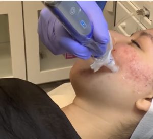 Client receiving microneedling treatment | AnewSkin Aesthetic Clinic and Medical Spa PRP Microneedling Vampire Facial in AnewSkin MedSpa Wshington DC