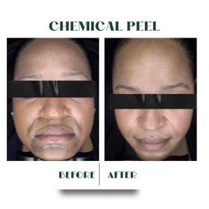 Anewskin custom chemical peels washington dc