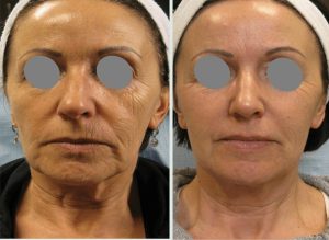 Anewskin Medspa Skin Rejuvenation in Washington DC