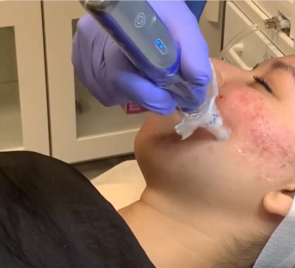 PRP Microneedling Vampire Facial in AnewSkin MedSpa Wshington DC